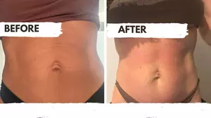 Weight Loss in Boca Raton - Deals Up to 70% Off