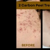 Image 5: Laser Hair Removal, Tattoo Removal, Carbon Peel, Acne Treatments