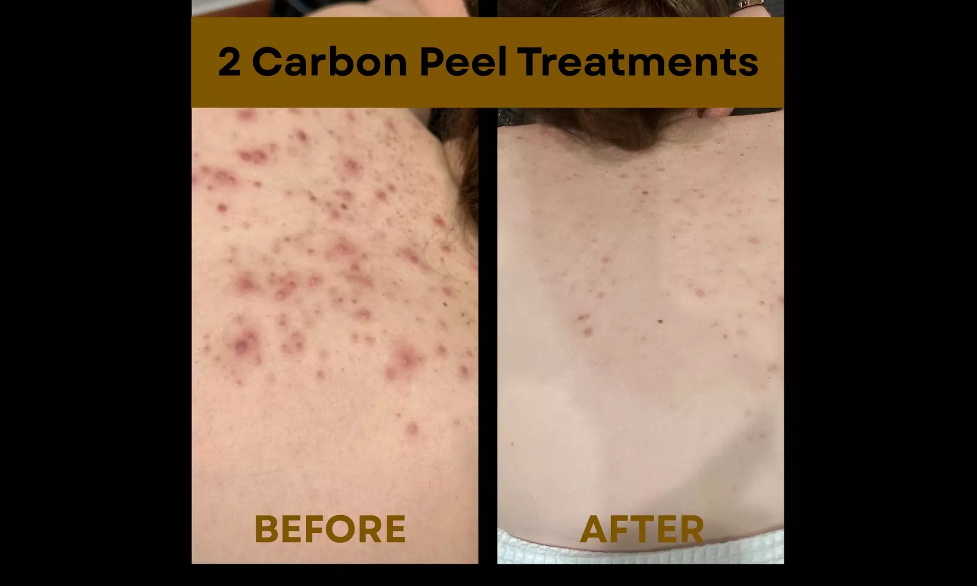 Laser Hair Removal Sessions or Laser Carbon Peel or Acne Treatments