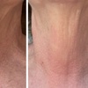 Image 2: Up to 31% Off on HydraFacial at Phoenix Esthetics of CT