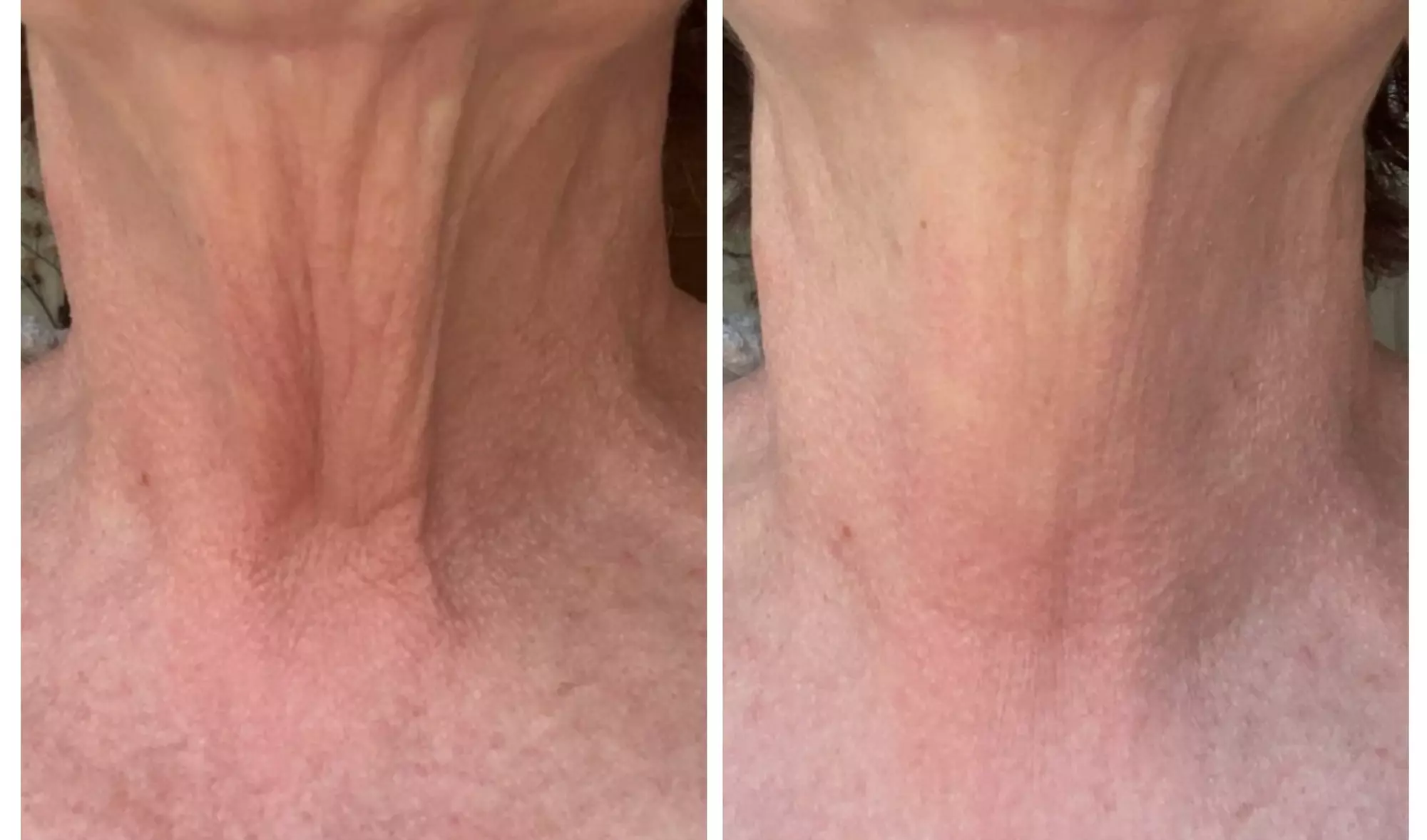 Up to 40% Off on HydraFacial at Phoenix Esthetics of CT