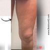 Image 1: Up to 53% Off Radio Frequency Skin Tightening at The Body Lux