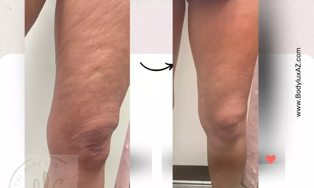 Up to 58% Off Radio Frequency Skin Tightening at The Body Lux