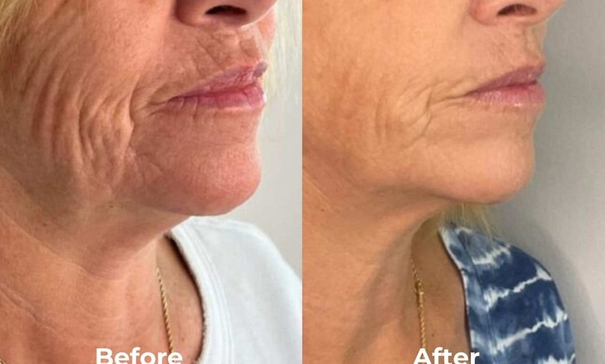 Image 5: Glow with 2 or 4 Thermal Rejuvenation Skin-Tightening Facial Lift