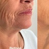 Image 5: Glow with 2 or 4 Thermal Rejuvenation Skin-Tightening Facial Lift