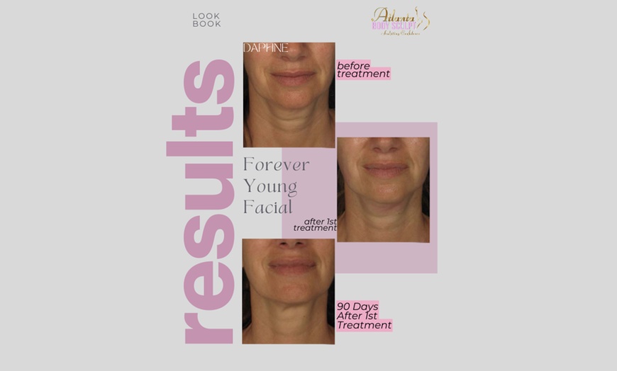 Image 5: Therma-Lift Facelifts for Youthful Skin with No Downtime