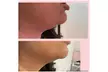 One, Two, or Four ThermaLift Skin-Tightening Facelifts at InstaSculpting (Up to 88% Off) - Second Medium