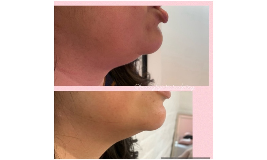 Image 3: One, Two, or Four ThermaLift Skin-Tightening Facelifts at InstaSculpting (Up to 88% Off)