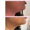Image 3: One, Two, or Four ThermaLift Skin-Tightening Facelifts at InstaSculpting (Up to 88% Off)