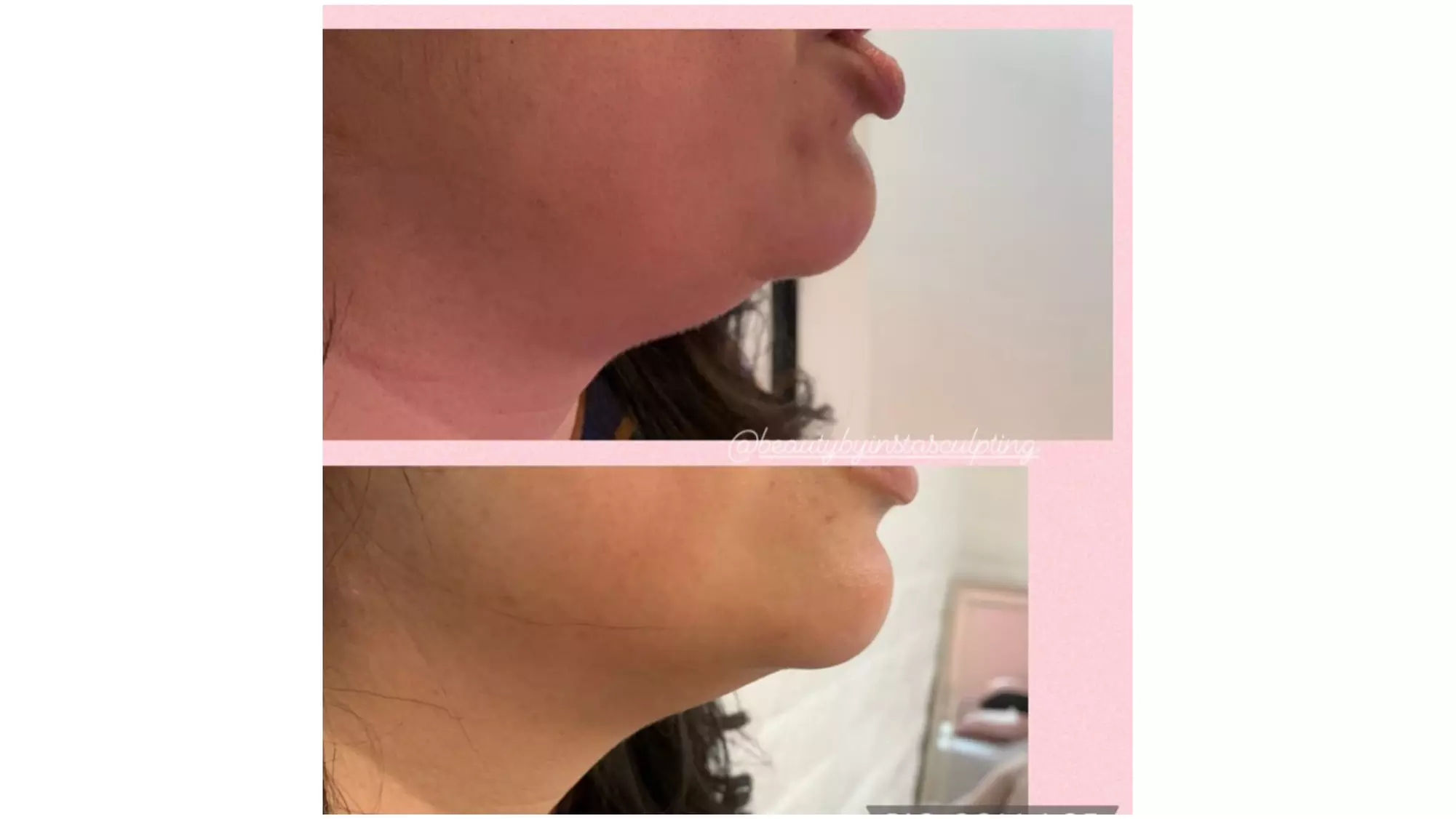 One, Two, or Four ThermaLift Skin-Tightening Facelifts at InstaSculpting (Up to 88% Off)