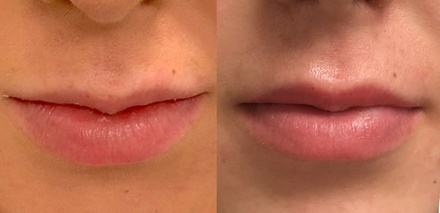 One Syringe of Juvederm Volbella Injection (0.55mL) - Edman Clinic
