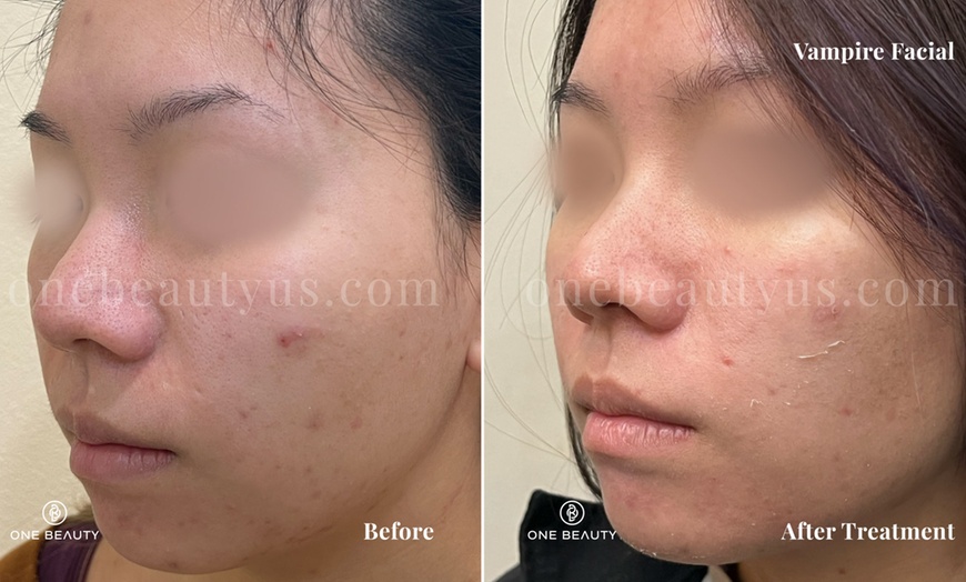 Image 2: Up to 82% Off on Microneedling at One Beauty Aesthetics