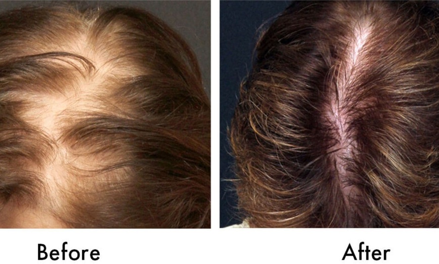 Image 3: PRP hair care to support thicker and fuller looking hair
