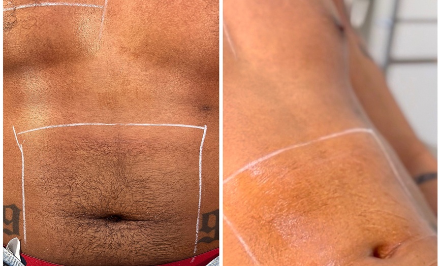 Image 4: 6 Laser Hair Removal on Small, Medium, Large, Extra-Large or Full Body