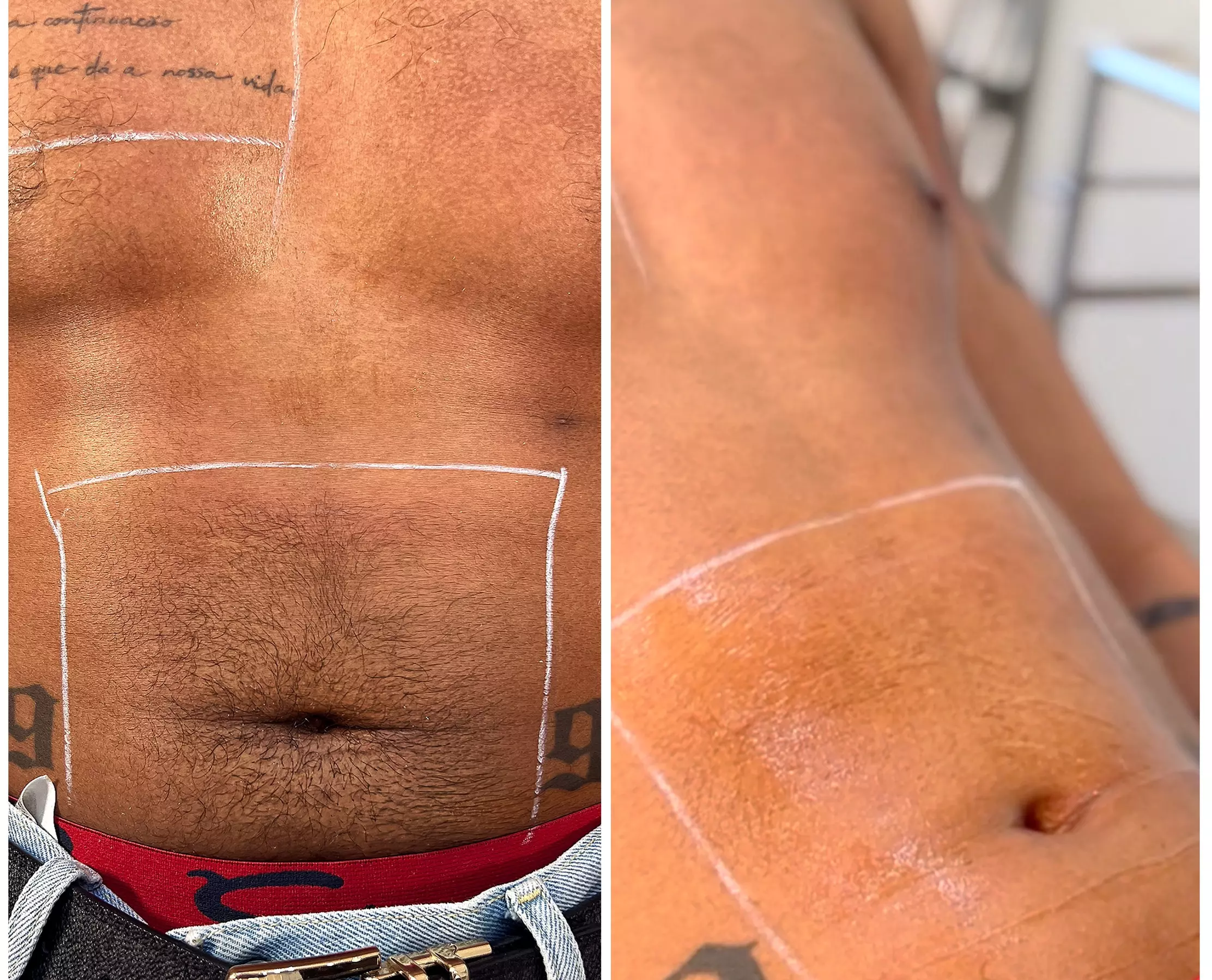 6 Laser Hair Removal on Small, Medium, Large, Extra-Large or Full Body