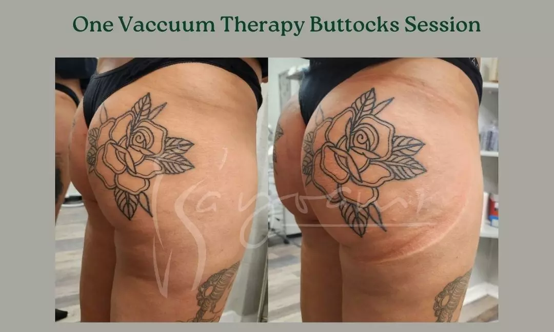 Vacuum Therapy Buttocks & Body Enhancement or CryoStatic Slimming