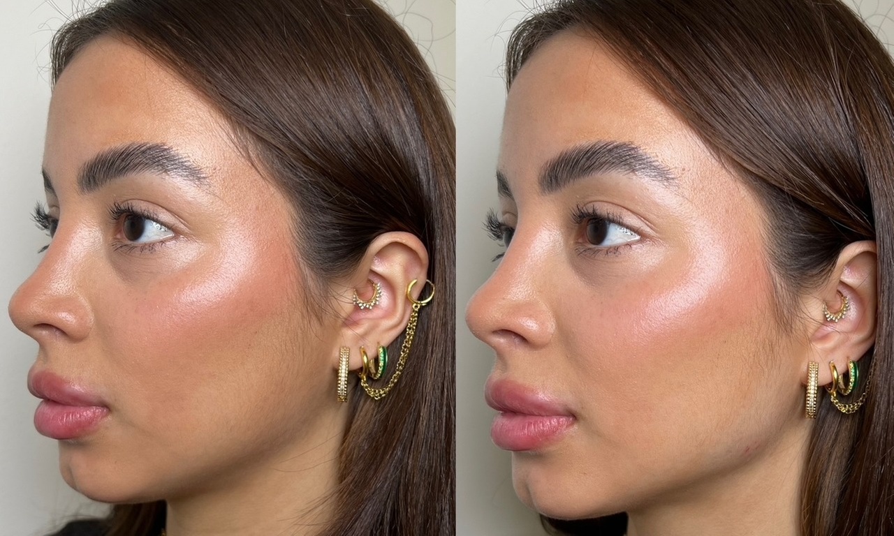 It's Time To Bring Your Youth Back w/ 20-60 Units of Botox