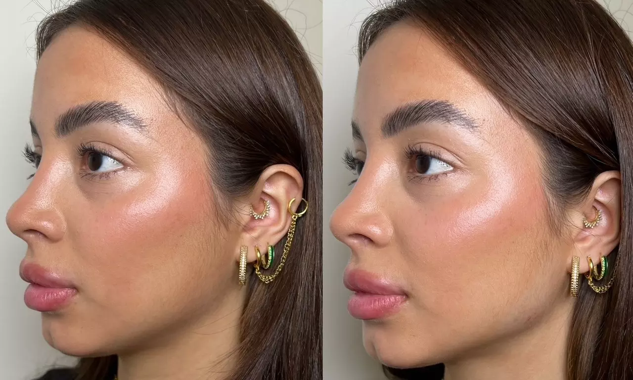 It's Time To Bring Your Youth Back w/ 20-60 Units of Botox