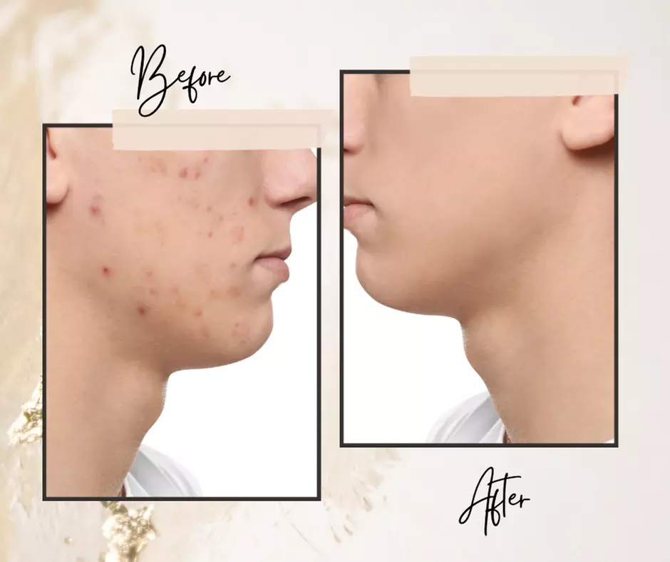 Experience One Facial and Acne Treatment Session for Fresh Skin at SkinTime Esthetics Corp. (Up to 54% Off) - Primary Image