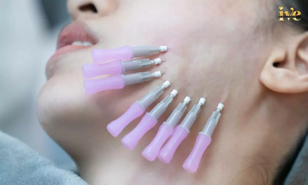 PDO or PCL Thread Lift Session: Jawline, Neck with Optional Nose, Face