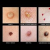 Image 3: Up to 50% Off on Plasma Pen Treatment at Gentlelase Laser Aesthetics