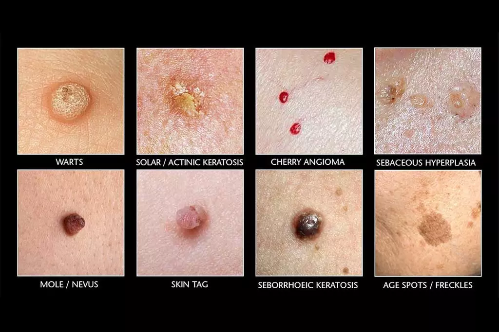 Plasma Pen for Skin Tags, Spots & Milia: Choose 5, 10, or 10+ Removals