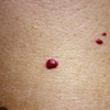 Image 1: Removal of 1, 2, or 3 Skin Tags, Angiomas, Milia, or Age Spots