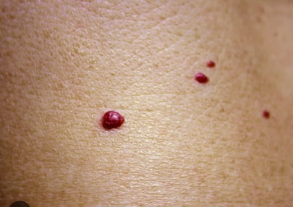 Removal of 1 Skin Tag, Cherry Angioma, Milia, or Age Spot - Reviva Hair & Skin Clinic