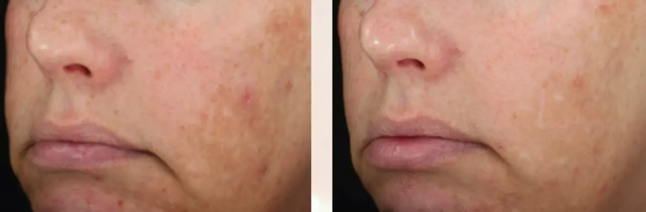 Enhance Your Skin with Deluxe Facial or Laser Diamond Glow Facial (Up to 60% Off) - Primary Image