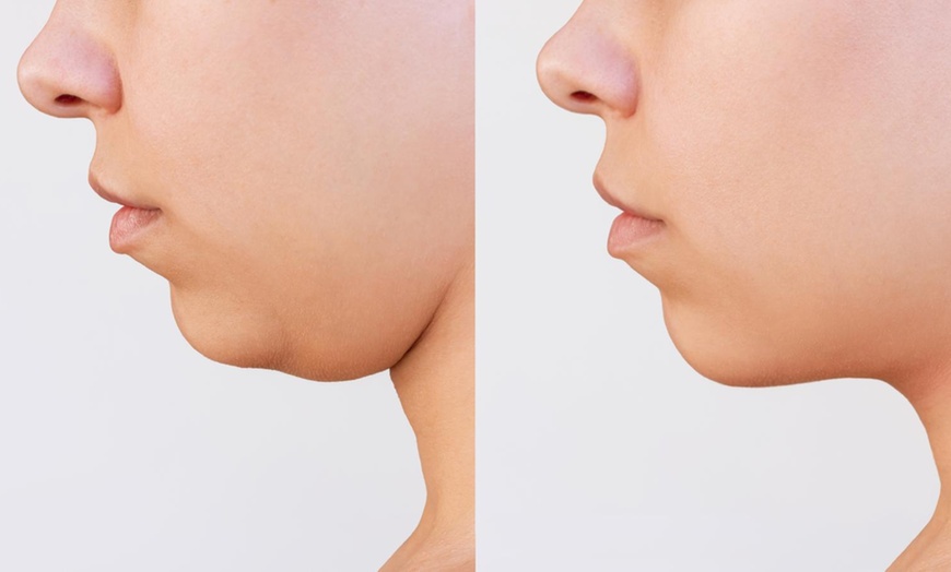 Image 1: Up to 47% Off on Double Chin Injection at Lov Med Spa