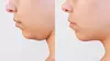 Up to 37% Off Fat Dissolve Double Chin Treatment at Lov Med Spa