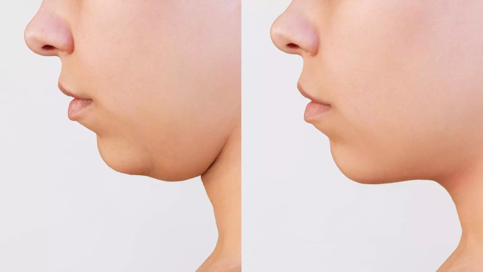 Up to 30% Off on Double Chin Injection at Lov Med Spa