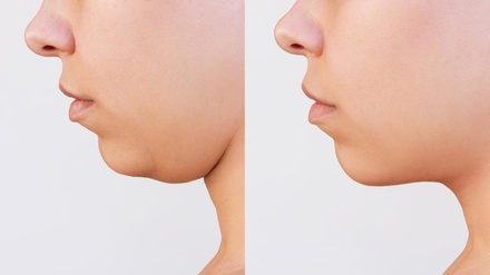 One Double Chin Rescue Treatment - Lov Med Spa