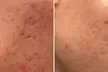 Up to 61% Off on Radio Frequency Skin Tightening at Aesthetics Care Med Spa - Second Medium