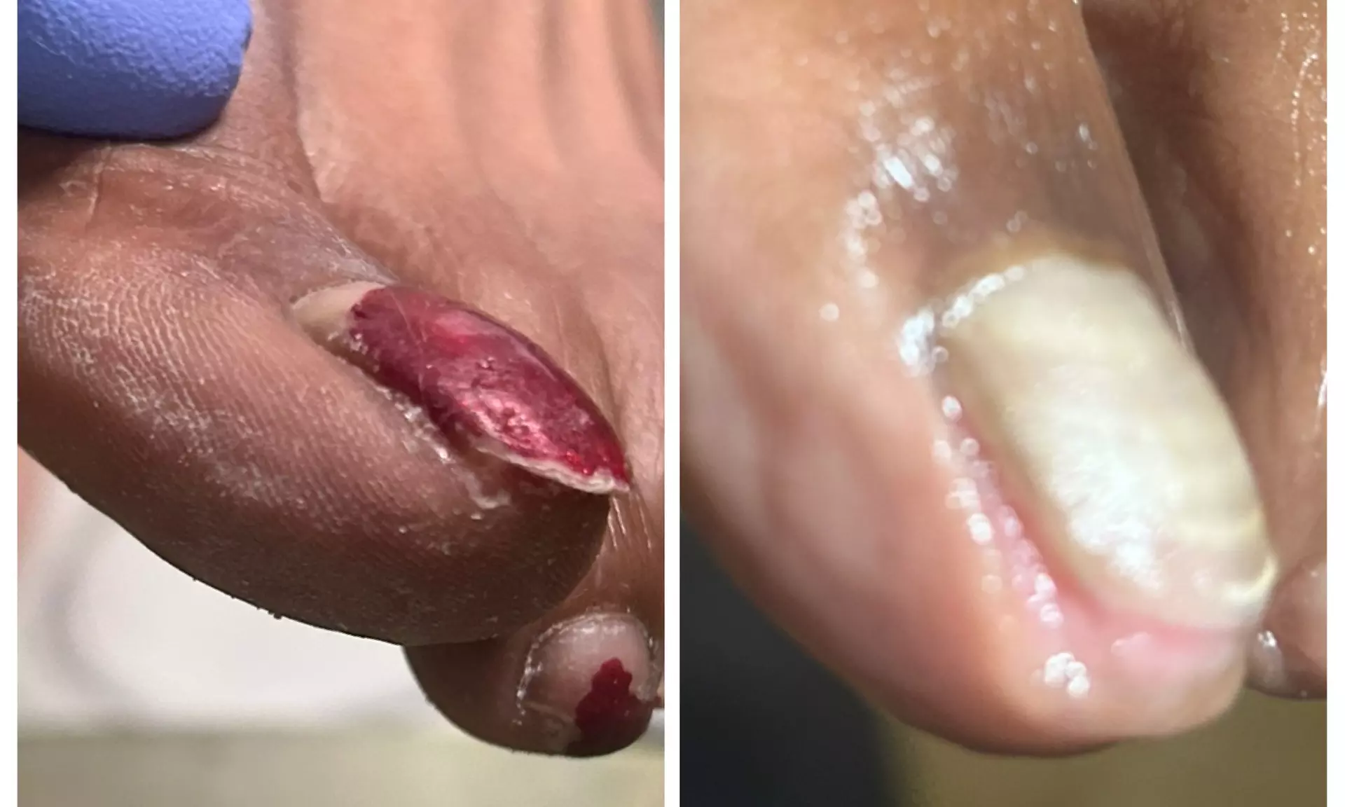 Get Medical Pedicure, Corn and Callus, Ingrown Toenails, Moisturizer - Up to 30% Off - Second Medium