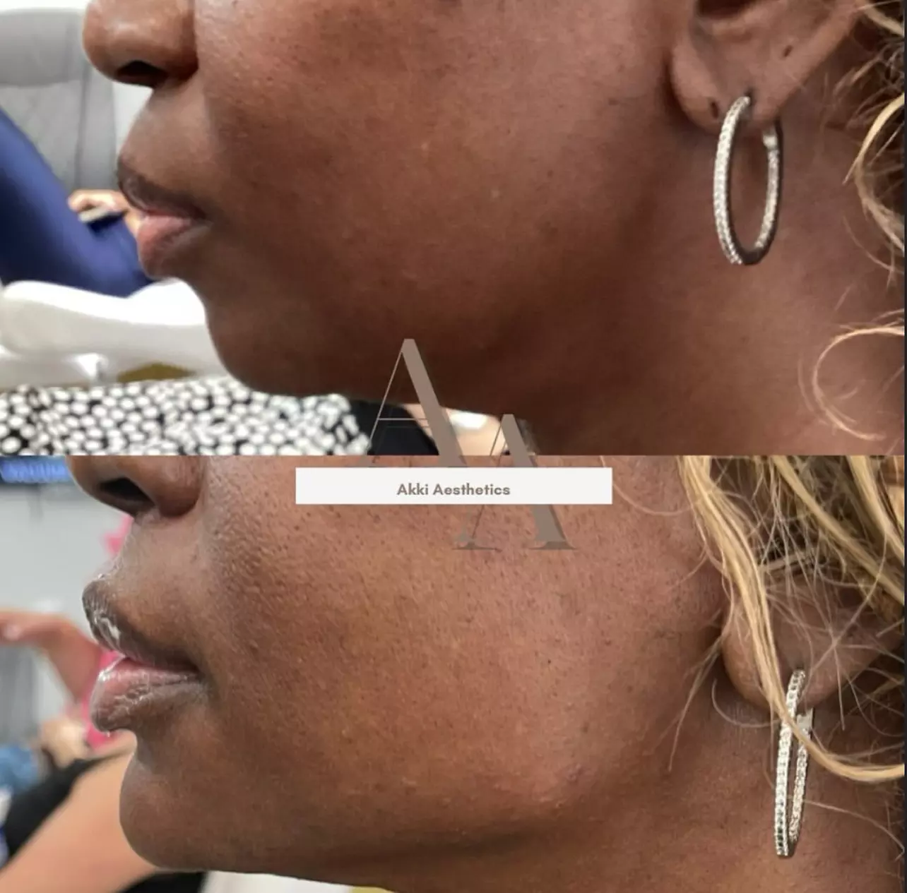 Enhance Your Look with Lip, Cheek or Chin Filler or a Russian Lip Flip Treatment (Up to 50% Off) - Second Medium