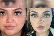 Up to 46% Off on Juvederm Injection - at PMU MD Aesthetics (Virtual Consultation Required) - Second Medium