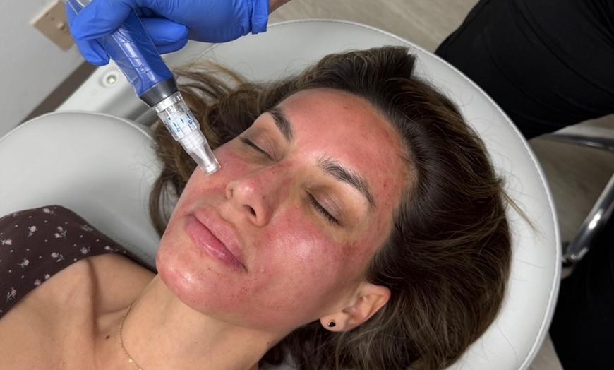 Image 4: Get One, or Three PRP Facials, Vampire Face Tightening & Microneedling