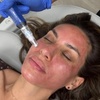 Image 4: Get One, or Three PRP Facials, Vampire Face Tightening & Microneedling