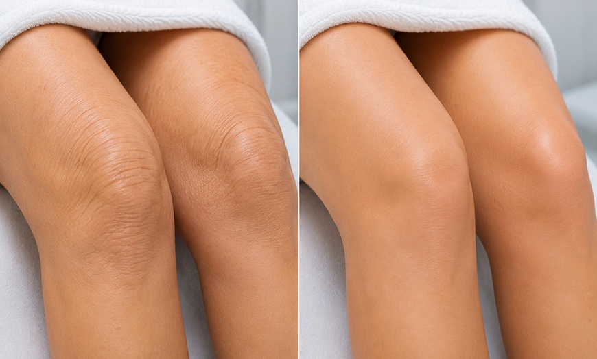 Image 2: Radio Frequency Skin Tightening at Body care Med Spa