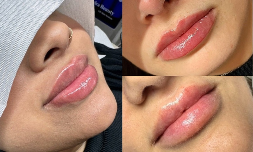 Image 3: Up to 61% Off on Injection - Dermal Filler at Skin Treat Aesthetics