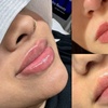 Image 3: Up to 61% Off on Injection - Dermal Filler at Skin Treat Aesthetics