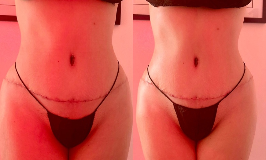 Image 2: Lymphatic Drainage Brazilian Detox Massage or Post-Op Massage