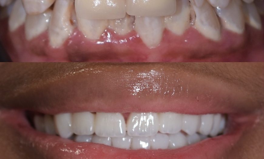 Image 5: Dental Crowns, Dental Exam, X-rays & Cleaning, Dentures & More