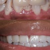Image 5: Dental Crowns, Dental Exam, X-rays & Cleaning, Dentures & More