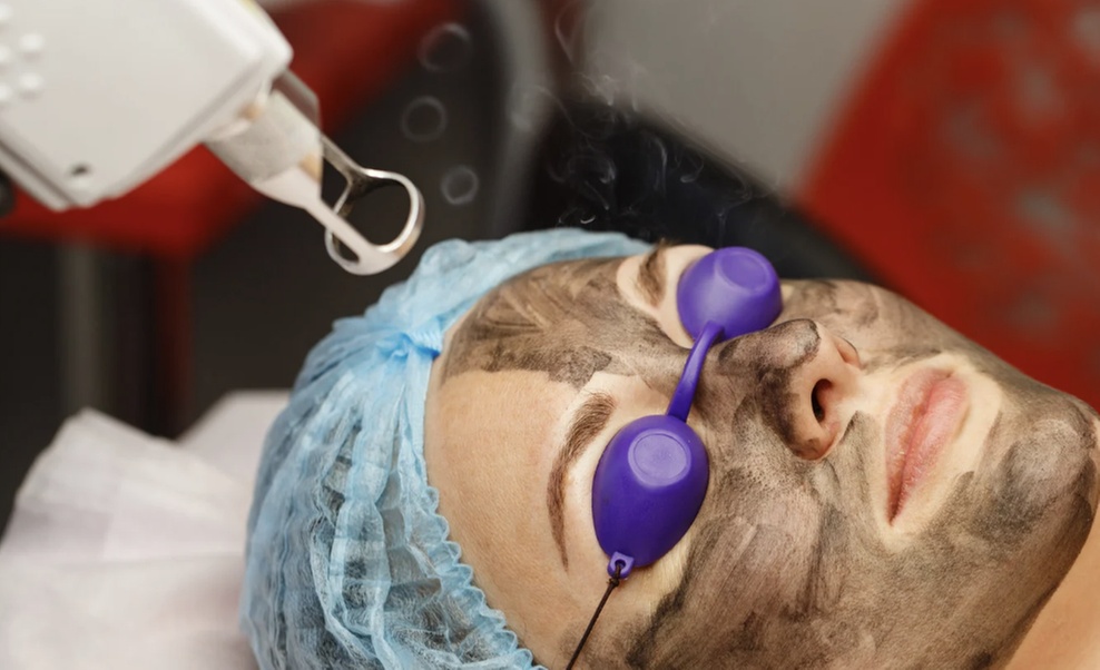 Carbon Peel PICO Laser Facial with RF Firming, Deep Cleanse & More