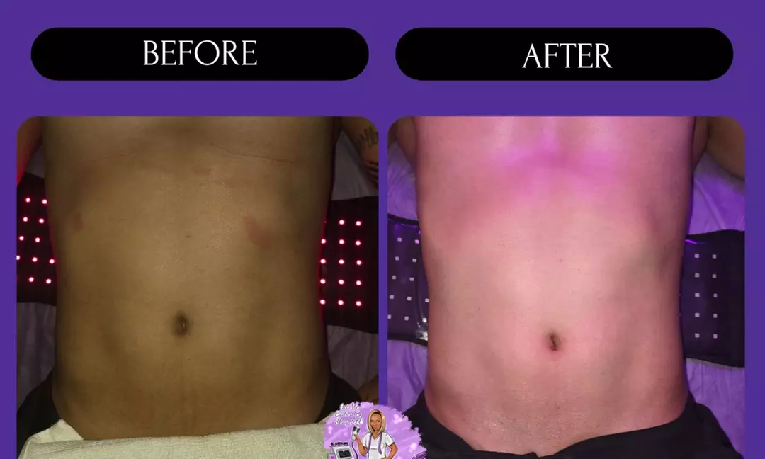 Post-Op Lymphatic Drainage Massages with Optional Wood Therapy