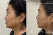 Up to 64% Off on Ultherapy / Ultrasonic Facial at One Beauty Aesthetics - Second Medium