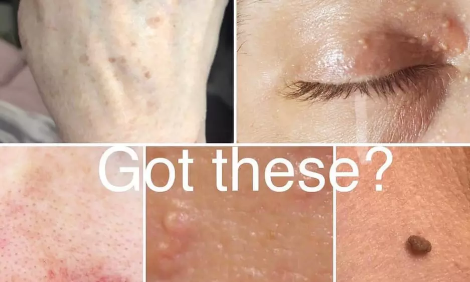 Experience West Valley Aesthetics' non-invasive skin tag and sun spot treatment with up to 40% off - Primary Image