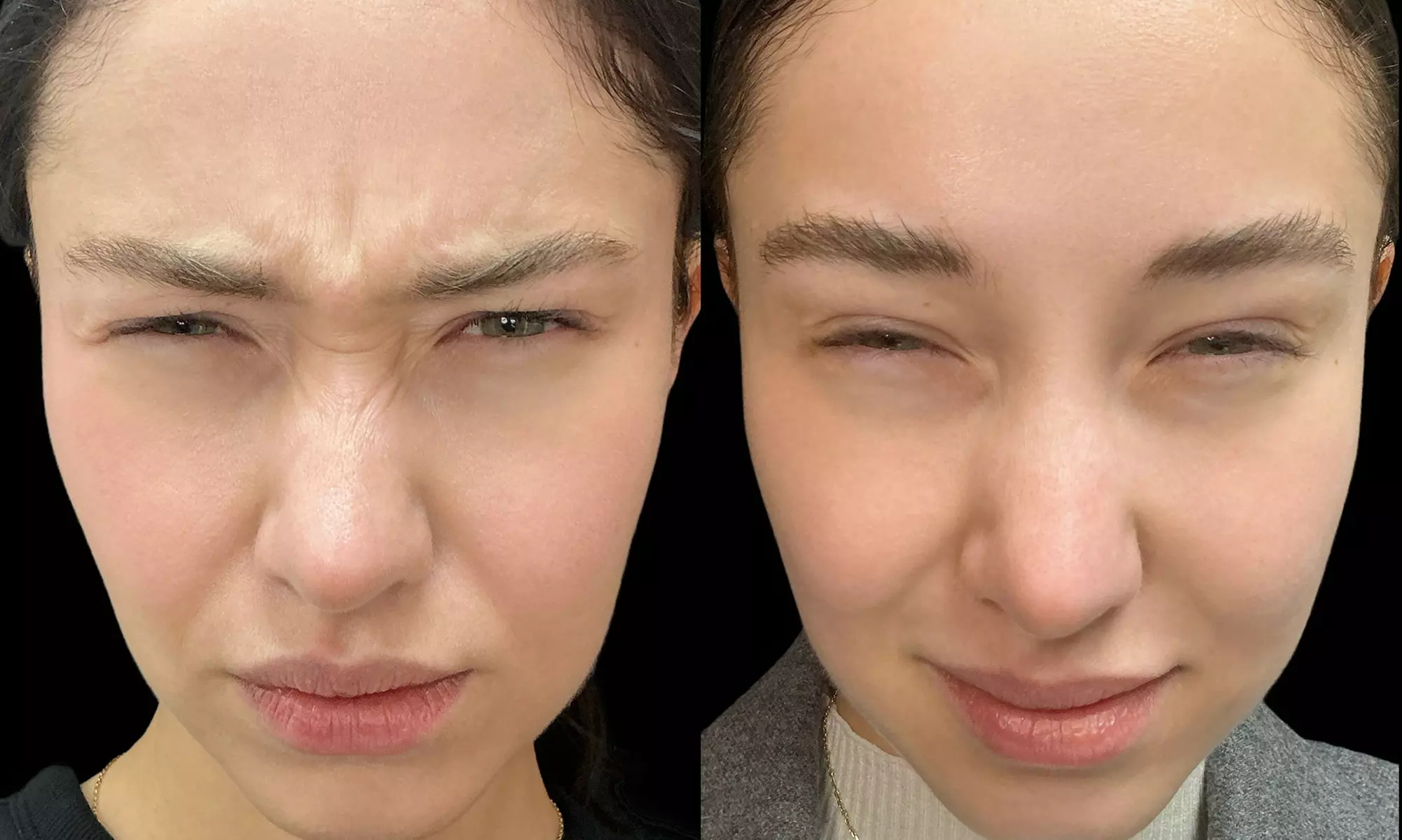 Smooth Away Lines with Botox Lip Flip, 20 or 40 Units of Botox